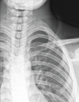 X-ray of person's chest